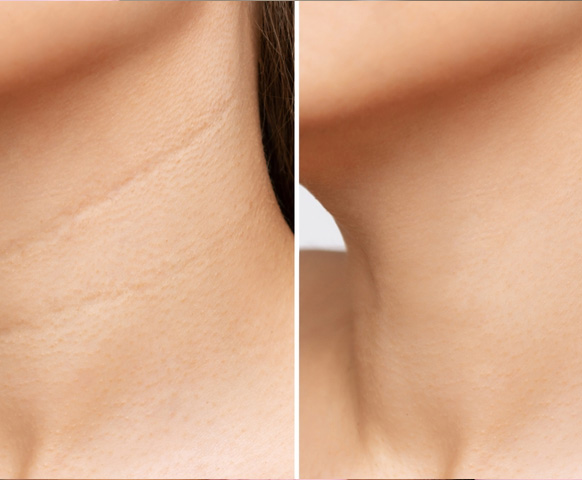 NECK CONTOURING LINES REDUCTION