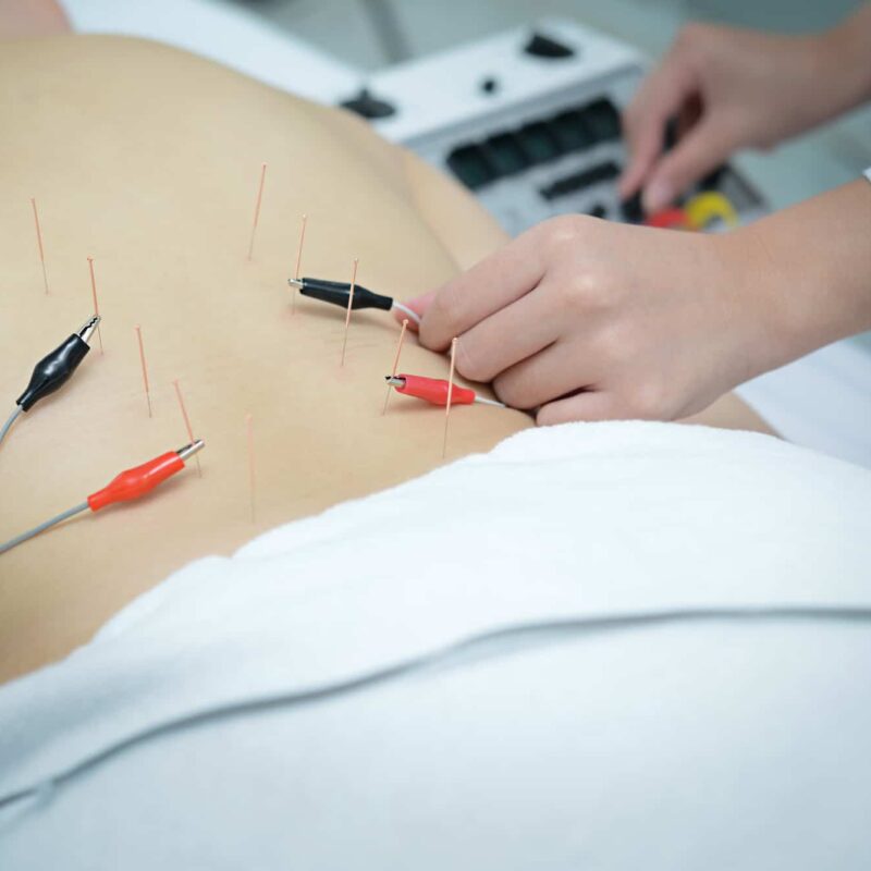 Acupunture whit functional electrical stimulation