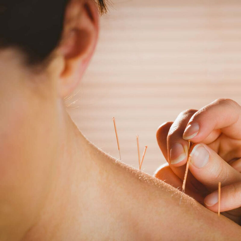 Pain Acupuncture initial.