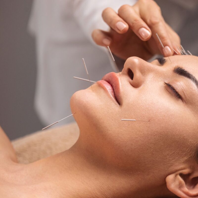 Acupuncture Facial