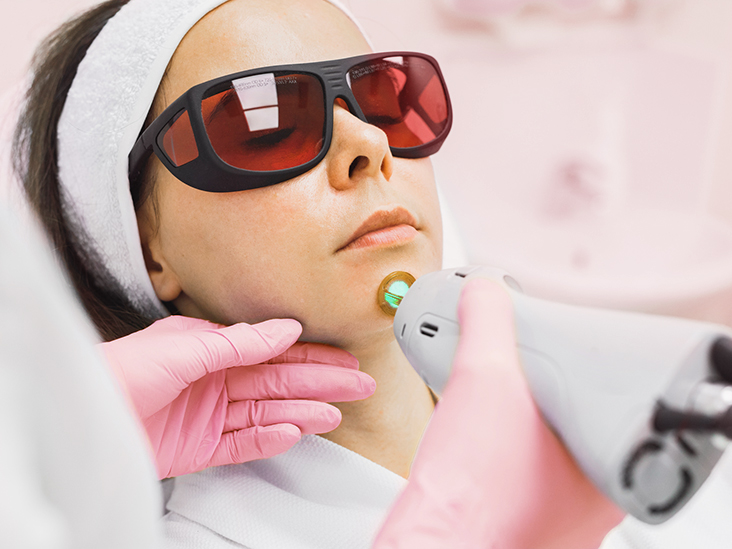 Chin Laser Hair Removal
