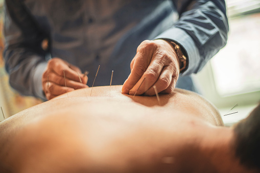 Coolsculpting & Acupuncture combo