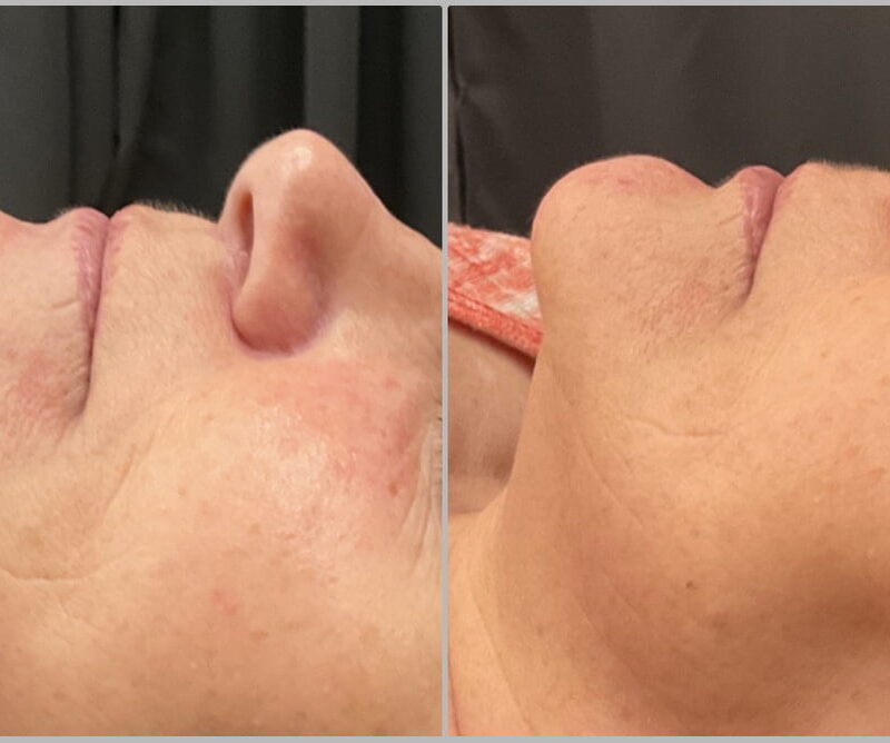CELLS REJUVENATION TREATMENT