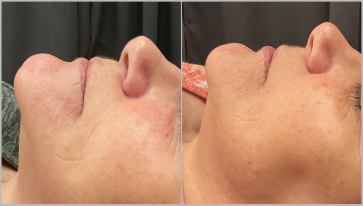 CELLS REJUVENATION TREATMENT