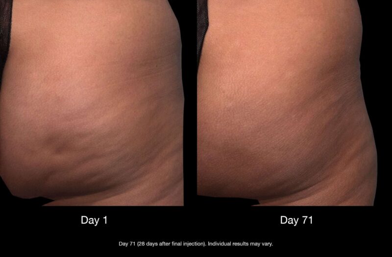 CELLULITE GLUTEOUS TREATMENT