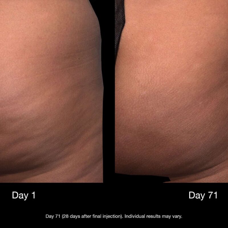 CELLULITE GLUTEOUS TREATMENT