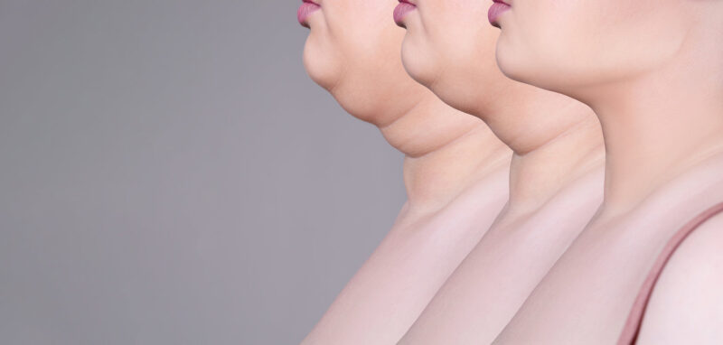LIPO FACE OB CHIN REDUCTION