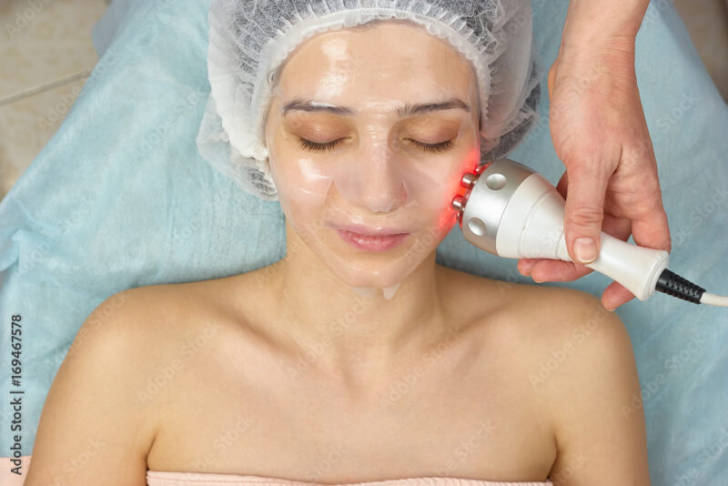 RF Facial Tightening