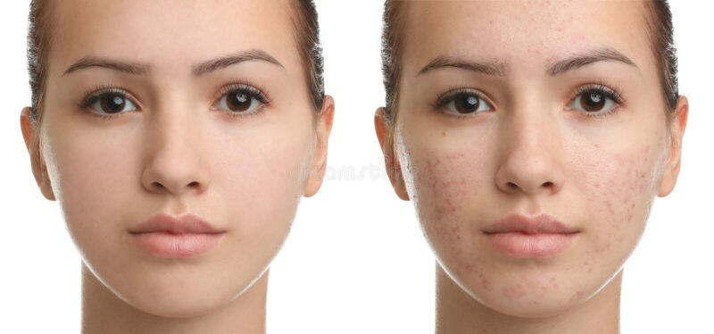 Salicylic Acid Chemical Peel