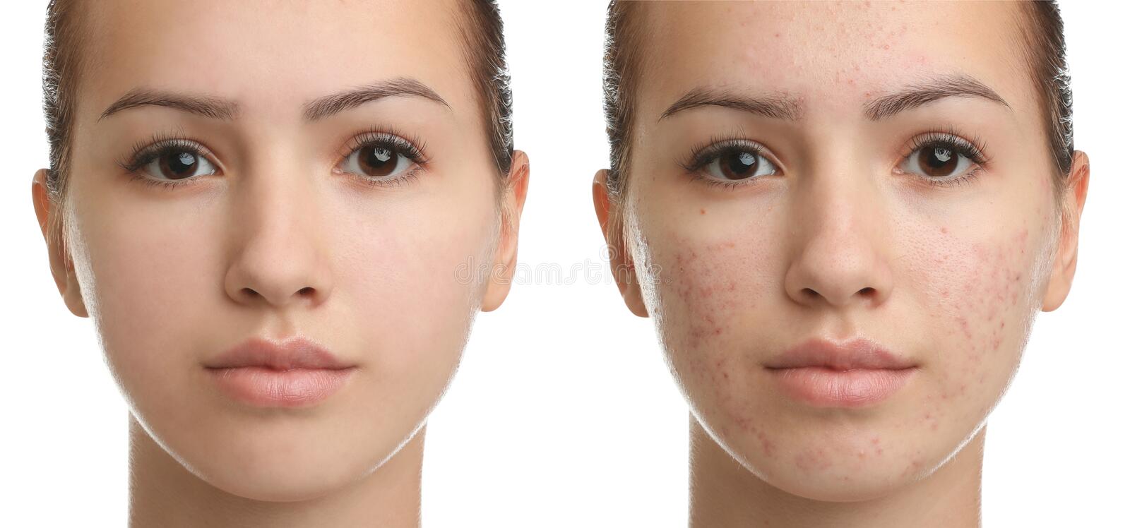 Salicylic Acid Chemical Peel